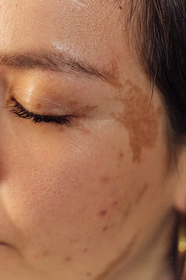 Anti Melasma: